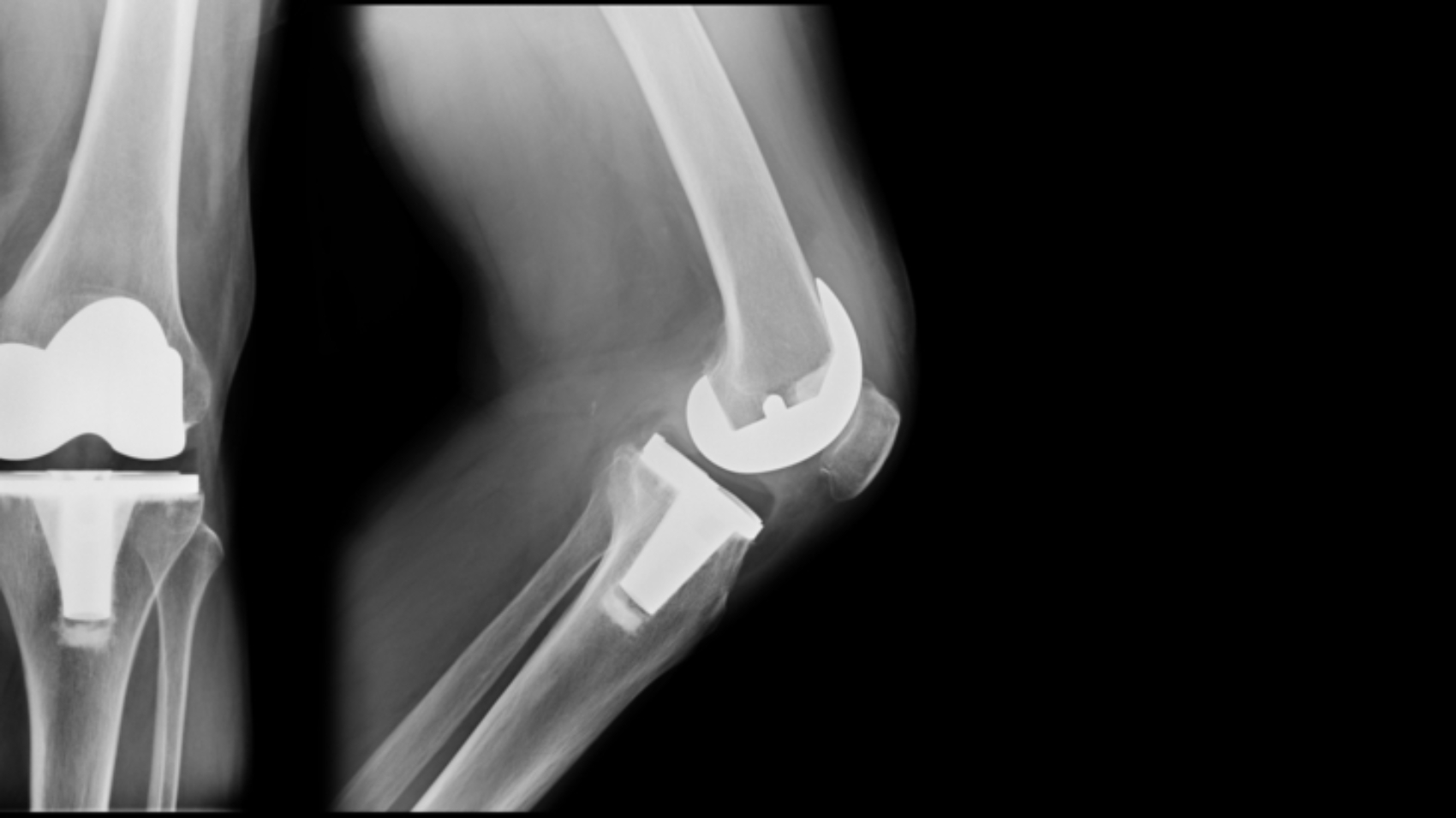 X-ray,Total,Knee,Replacement